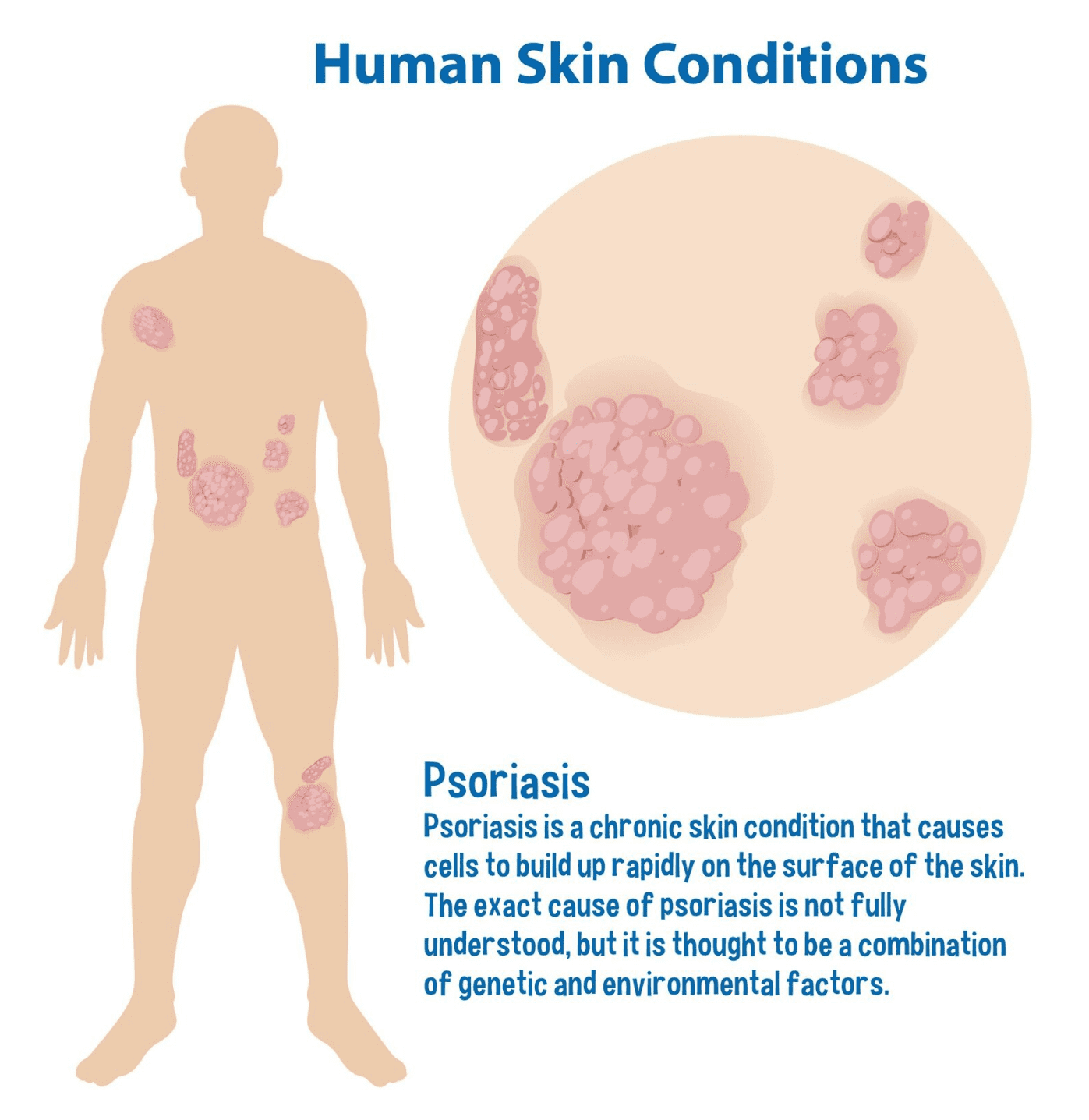 Child with psoriasis – unique pediatric management