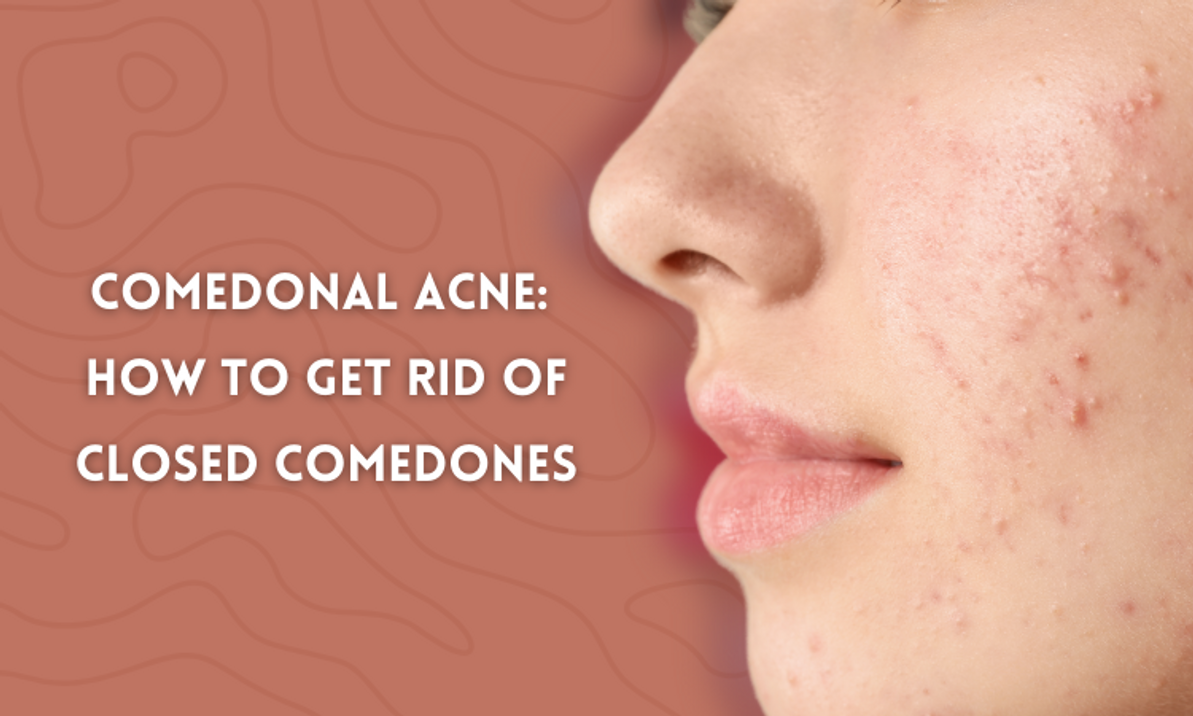 Comedonal Acne: How to Get Rid of Closed Comedones